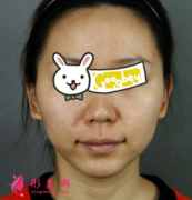 成都友誼醫(yī)院整形科顴骨內(nèi)推案例，線條流暢