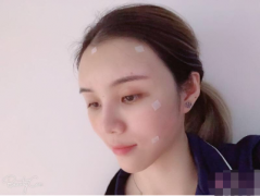 廣州曙光醫(yī)學(xué)美容醫(yī)院自體脂肪全面部填充怎么樣？附案例分享