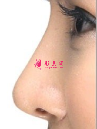 假體隆鼻后呼吸有些不通暢怎么辦