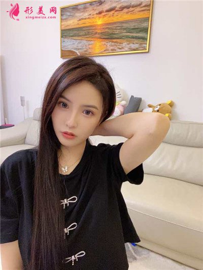 深圳定點雙眼皮術后恢復效果分享
