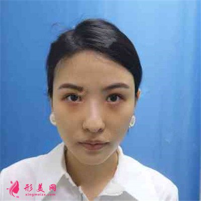 深圳定點雙眼皮術后恢復效果分享