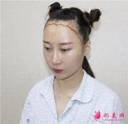 成都恒博植發(fā)發(fā)際線種植術(shù)后恢復(fù)情況分享