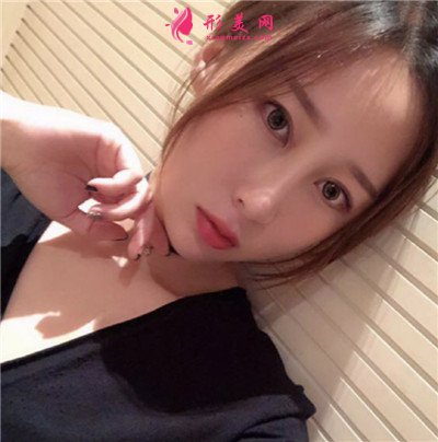 云南新華發(fā)際線種植術后恢復情況分享