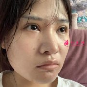北京彤美醫(yī)療美容醫(yī)院小仙女的硅膠假體隆鼻術(shù)后效果反饋