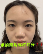 重慶軍美整形醫(yī)院好不好？隆鼻案例