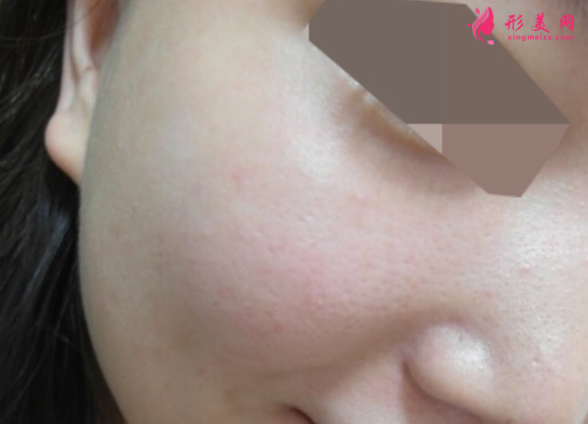 超光子嫩膚效果可以保持多久