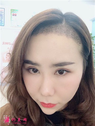 成都植發(fā)際線1700單位術(shù)后效果對(duì)比圖分享