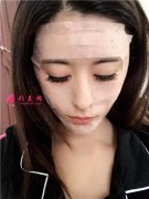 四川華人醫(yī)聯(lián)整形美容醫(yī)院小仙女鼻綜合手術(shù)術(shù)后案例反饋