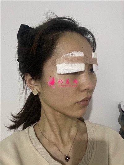 昆明眼部多項(xiàng)手術(shù)術(shù)后效果對(duì)比