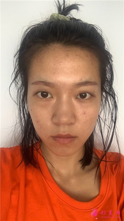 烏魯木齊眼綜合術(shù)后案例反饋
