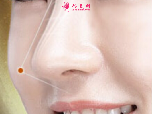 假體隆鼻價格大概是多少