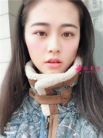 武漢全切雙眼皮術(shù)后恢復(fù)效果展示分享