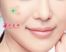 激光祛痘印什么時(shí)候看到效果