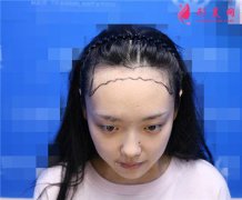 杭州同榮麗格醫(yī)療美容發(fā)際線種植術(shù)后恢復(fù)情況對比