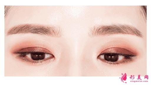 埋線雙眼皮的價(jià)格需要多少錢