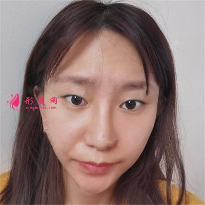 廣州定點雙眼皮術后效果展示