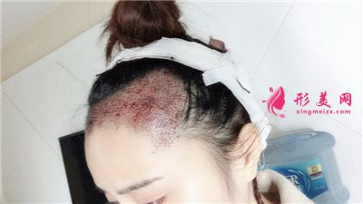 成都恒博種植發(fā)際線手術術后效果展示