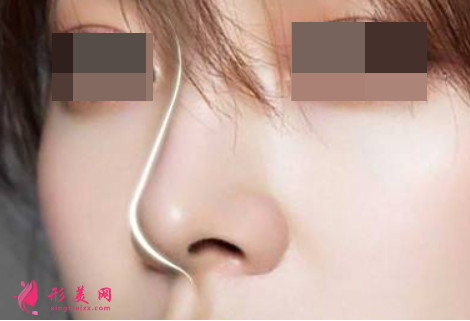 自體軟骨隆鼻的原理和優(yōu)勢