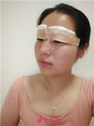 廈門思明海峽醫(yī)療美容門診部全切雙眼皮手術(shù)術(shù)后效果對比
