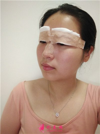 廈門全切雙眼皮手術(shù)術(shù)后效果對比