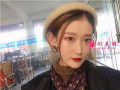 北京潤美玉之光醫(yī)療美容小仙女全切雙眼皮術(shù)后恢復(fù)情況反饋