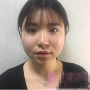廣州曙光醫(yī)學(xué)美容醫(yī)院怎么樣？吸脂瘦臉術(shù)后反饋