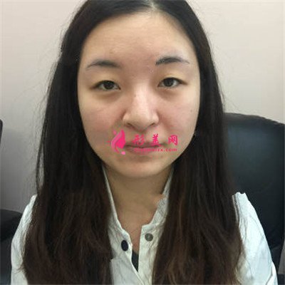 廣州全切雙眼皮術(shù)后恢復(fù)情況對(duì)比