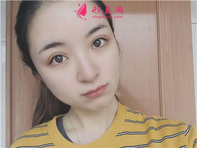 廣州全切雙眼皮術(shù)后恢復(fù)情況對(duì)比