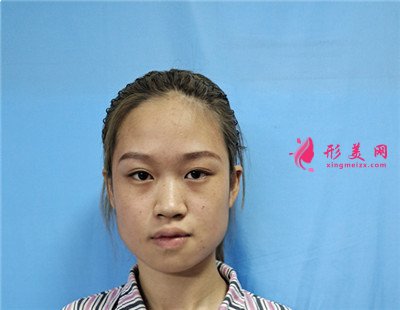 湖南小姐姐吸脂瘦臉術后效果反饋