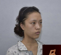 成都武侯蓉美和諧醫(yī)療美容面部填充怎么樣？術(shù)后恢復(fù)過程圖分享