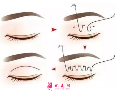 雙眼皮手術(shù)有哪些常見的風(fēng)險(xiǎn)