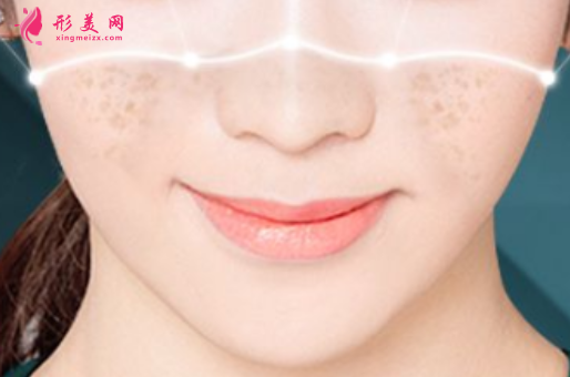 激光祛斑恢復(fù)期內(nèi)要怎么護(hù)理