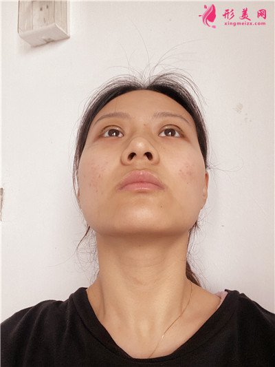 深圳眼綜合手術(shù)術(shù)后恢復(fù)情況對比