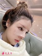 重慶聯(lián)合麗格美容醫(yī)院耳軟骨隆鼻術后恢復效果分享