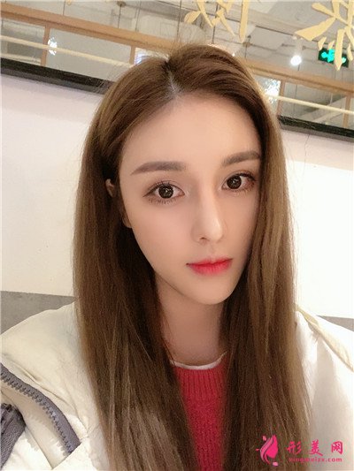 重慶耳軟骨隆鼻術(shù)后恢復(fù)效果分享