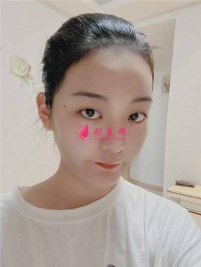 杭州發(fā)際線調(diào)整術(shù)后恢復效果對比