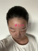 杭州同榮麗格醫(yī)療美容發(fā)際線(xiàn)調(diào)整術(shù)后恢復(fù)效果對(duì)比
