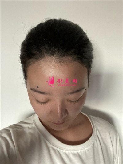 杭州發(fā)際線調(diào)整術(shù)后恢復效果對比