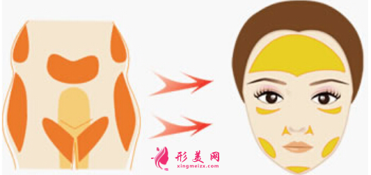 自體脂肪填充臉部脂肪存活率跟什么有關(guān)