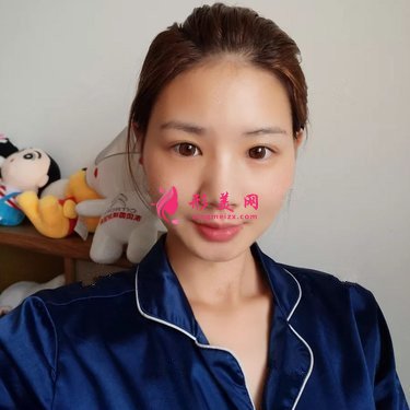 武漢自體脂肪面部填充術(shù)后效果反饋