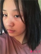 杭州華山連天美醫(yī)療美容醫(yī)院面部埋線提升術(shù)后恢復情況分析