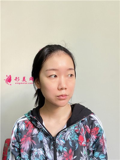 蘇州小姐姐全切雙眼皮術(shù)后效果對比