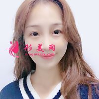 自體脂肪活細胞除皺真實體驗分享