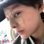 四川華人醫(yī)聯(lián)硅膠墊鼻梁兩個月了，效果非常不錯看圖