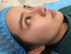 雙眼皮平行扇形案例對比圖：三庭五眼中的桃花眼~