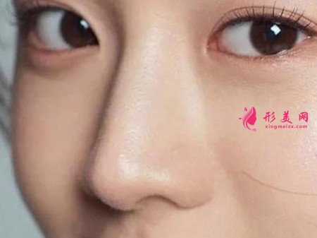 假體隆鼻以后可以取出來嗎