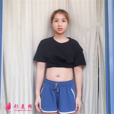 鄭州腰腹吸脂手術術后效果反饋