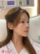 廣州廣大整形美容醫(yī)院軟骨隆鼻術(shù)后恢復(fù)情況對比
