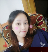 成都圣丹福整形劉晶醫(yī)生注射瘦臉針怎么樣？看我的術后效果還不錯