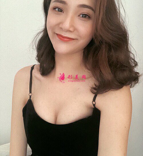 南京華美沈正宇醫(yī)師真人隆胸案例 50天前后對(duì)比圖分享